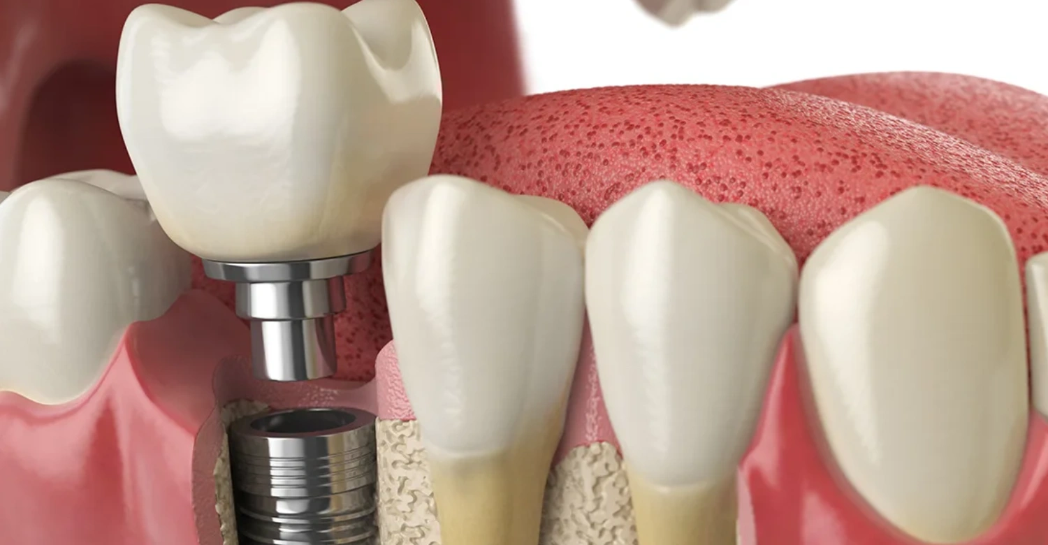 How Much Is 4 Dental Implants in Turkey Inblog